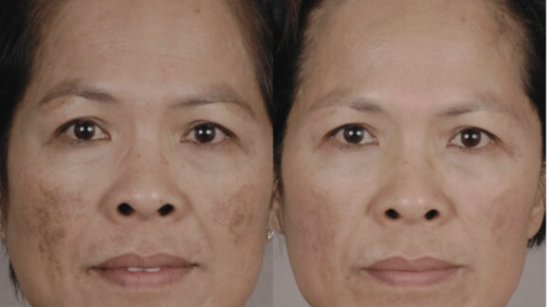 Leia mais sobre o artigo Melasma: Causa, Fatores, Prevenção e Tratamento